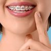 (P) Investiția &icirc;n Estetică: De ce Aparatul Dentar Ceramic este Soluția de Mijloc Ideală &icirc;ntre Metal și Safir