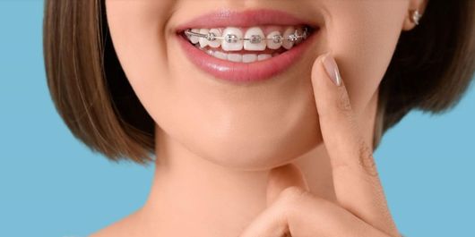 (P) Investiția în Estetică: De ce Aparatul Dentar Ceramic este Soluția de Mijloc Ideală între Metal și Safir
