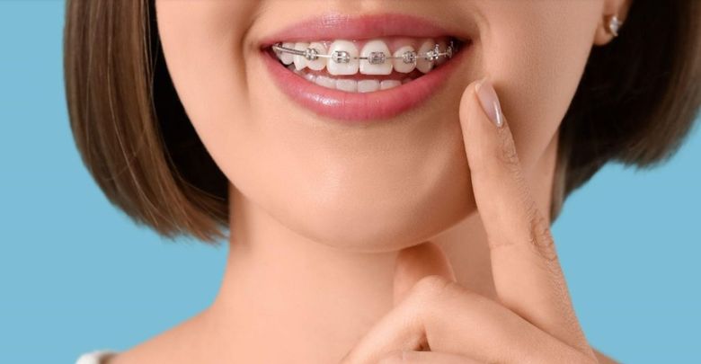 (P) Investiția în Estetică: De ce Aparatul Dentar Ceramic este Soluția de Mijloc Ideală între Metal și Safir