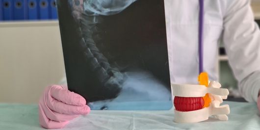 (P) Osteofitoza: ce este, de ce apare și cum se tratează?
