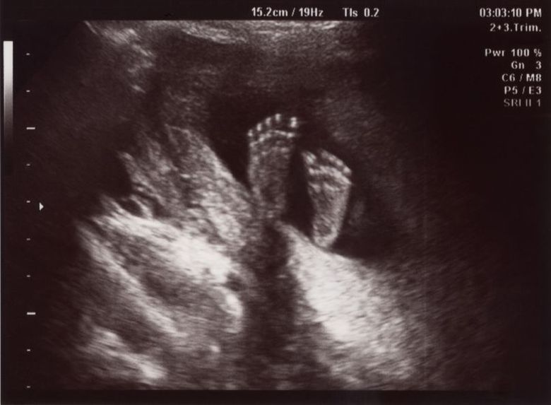 A făcut sex cu iubitul ei, la scurt timp şi cu amantul, iar apoi a aflat că este gravidă! Medicii s-au crucit când au văzut ce se întâmplă în uterul ei!