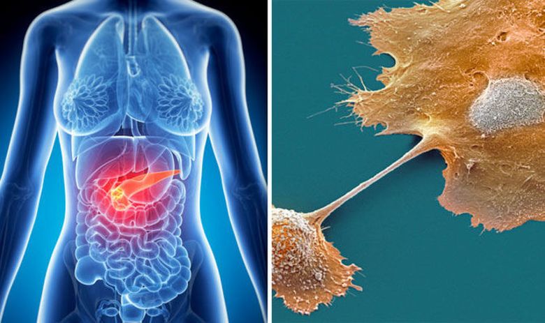 Cancerul pancreatic: semnele timpurii care iti pot salva viata