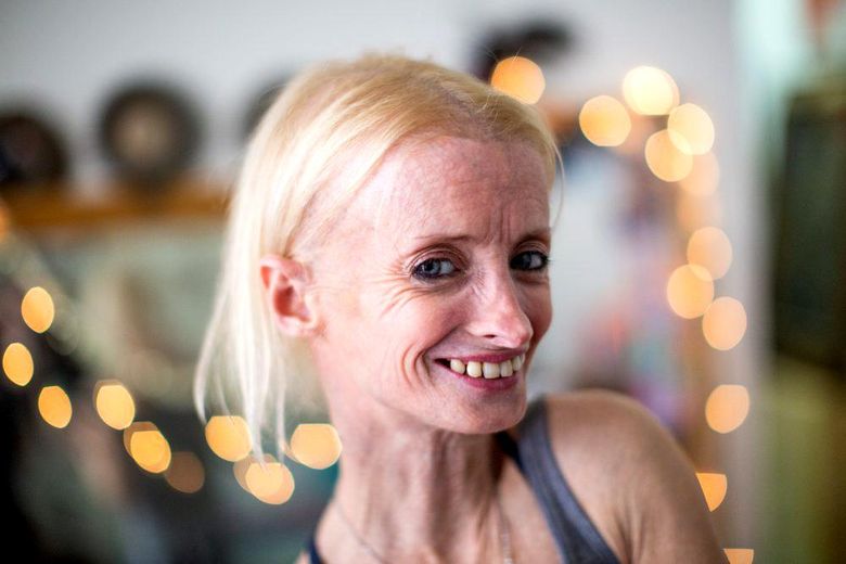 Femeia care îmbătrânește de 8 ori mai repede decât ar fi normal. Povestea cutremurătoare