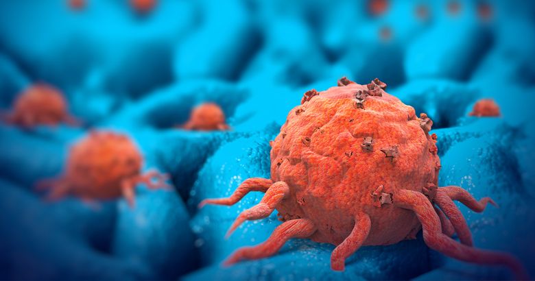 Cancerul la femei: simptomele care anunță această afecțiune Cancerul la femei: simptomele care anunță această afecțiune