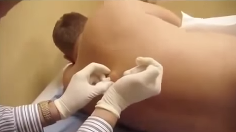 Avea un chist pe spate. Doctorul şi asistentele, aproape de leşin când au văzut ce avea acolo cu adevărat Avea un chist pe spate. Doctorul şi asistentele, aproape de leşin când au văzut ce avea acolo cu adevărat
