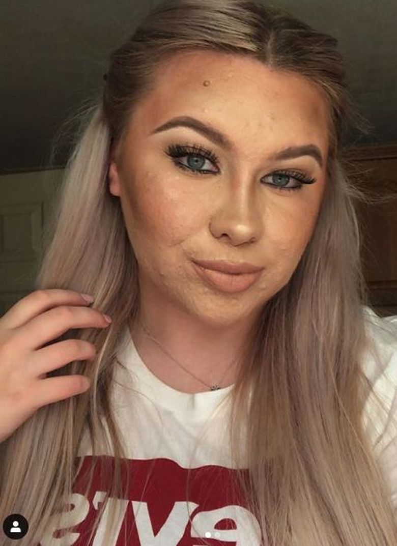 Cum arată fără machiaj Abigail, tânăra care are nevoie de două ore pe zi pentru a-şi ascunde acneea