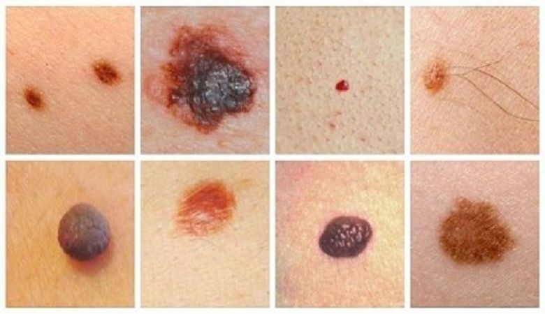 Cum putem identifica acasa alunitele cu potential cancerigen Cum putem identifica acasa alunitele cu potential cancerigen