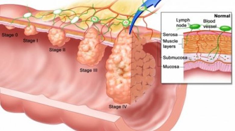 6 simptome ale CANCERULUI DE COLON pe care nu trebuie să le ignori 6 simptome ale CANCERULUI DE COLON pe care nu trebuie să le ignori