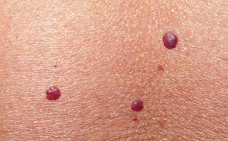 Ai alunițe roșii pe piele? Uite ce trebuie să știi neapărat! Ai alunițe roșii pe piele? Uite ce trebuie să știi neapărat!