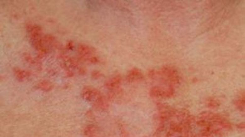 Cum să te ferești de cancerul de piele! Recomandări practice!