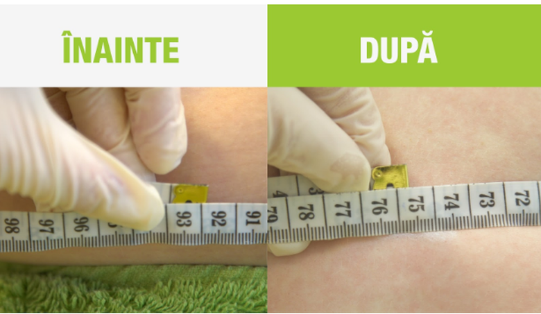 Trei tratamente pentru o silueta impecabilă