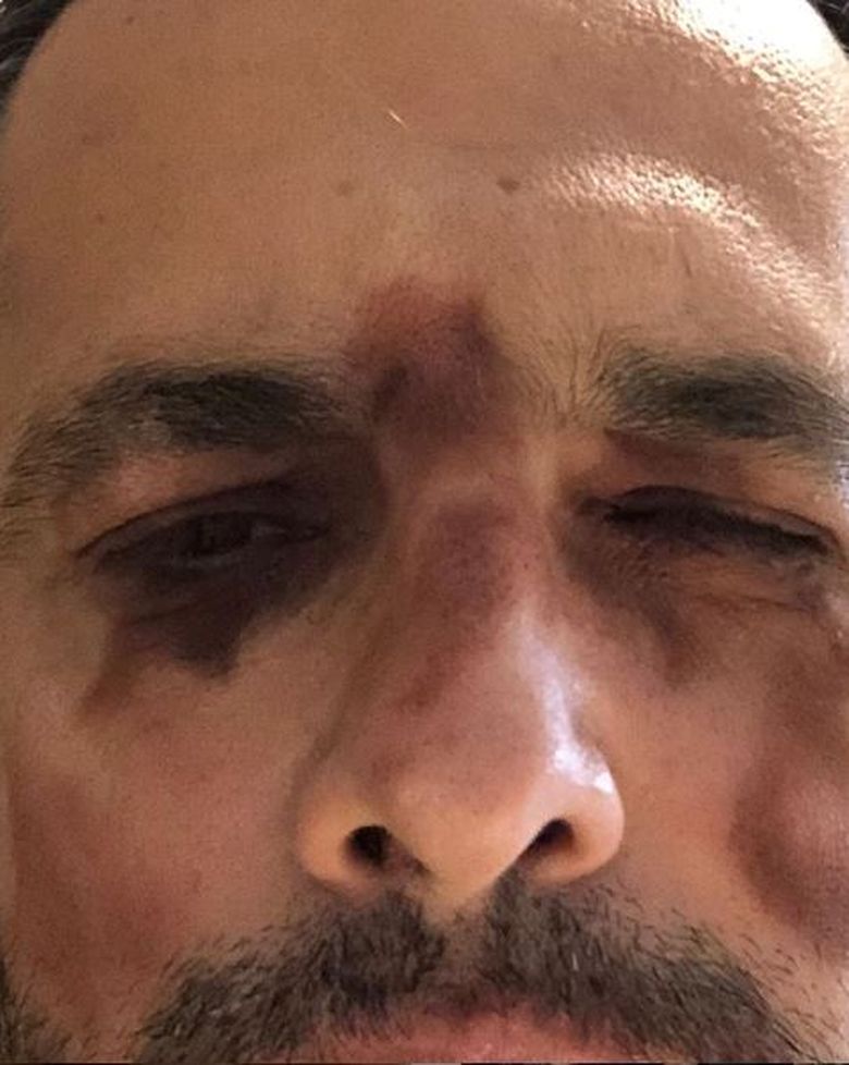 Mădălin Ionescu, bătut?! Și-a speriat fanii cu această fotografie: „Am rămas șocat când m-am văzut în oglindă” Mădălin Ionescu, bătut?! Și-a speriat fanii cu această fotografie: „Am rămas șocat când m-am văzut în oglindă”