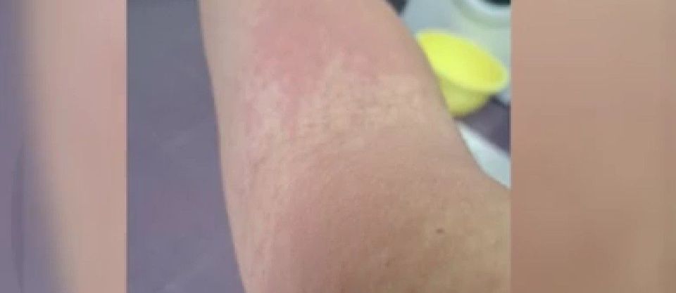 O femeie a fost la un pas de moarte, după ce a cumpărat o cremă cu mercur de 500 de lei