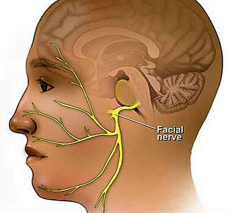 Sindromul Ramsay Hunt