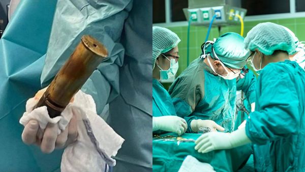 Dimineața Nebună:  Un bătrân s-a prezentat la spital cu un obuz înfipt în posterior: „Așa ceva, n-am mai văzut!” - AUDIO