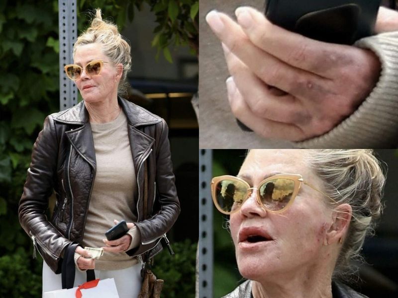 Melanie Griffith, surprinsă cu răni pe față și vânătăi pe mâini