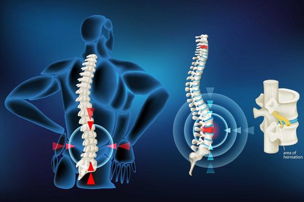 Hernia de disc: care sunt simptomele și tratamentul acesteia !