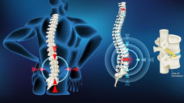 Hernia de disc: care sunt simptomele și tratamentul acesteia !