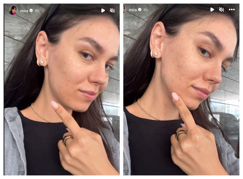 Mira s-a umplut de bube