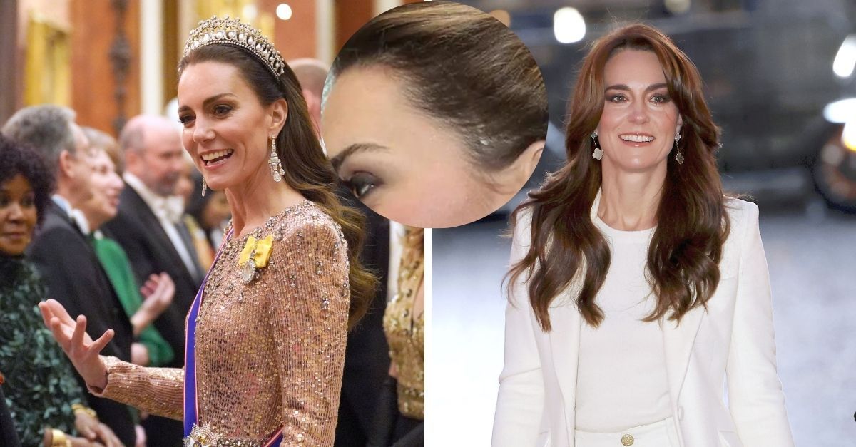 Kate Middleton a mai suferit o interventie chirurgicala