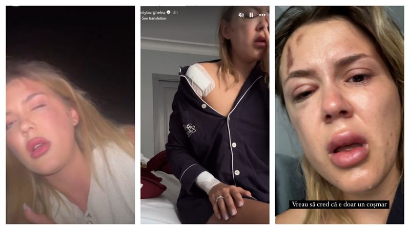 Emily Burghelea, desfigurată după accident