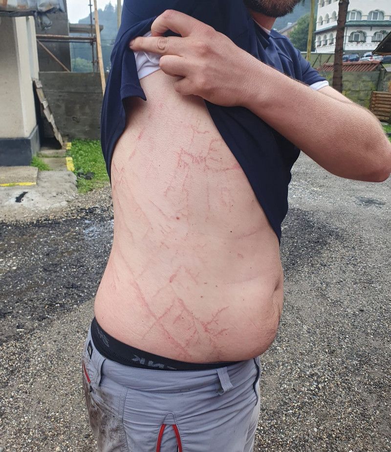 Semnele fulgerului pe corpul unui om 