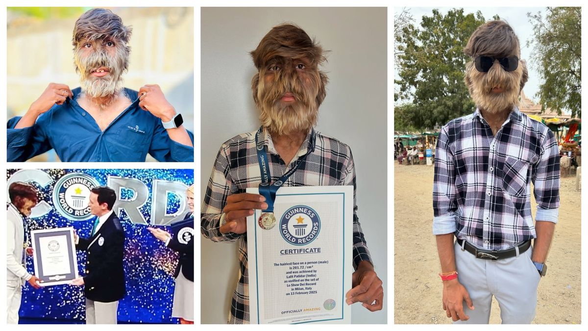 Tânăr diagnosticat cu sindromul vârcolacului