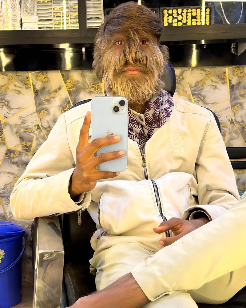 Tânăr diagnosticat cu sindromul vârcolacului