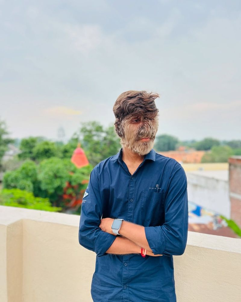 Tânăr diagnosticat cu sindromul vârcolacului