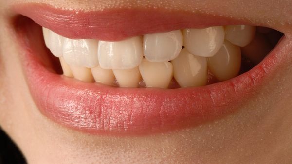 Ce presupune tratamentul cu fațete dentare și cum te poate ajuta să ai zâmbetul la care ai visat