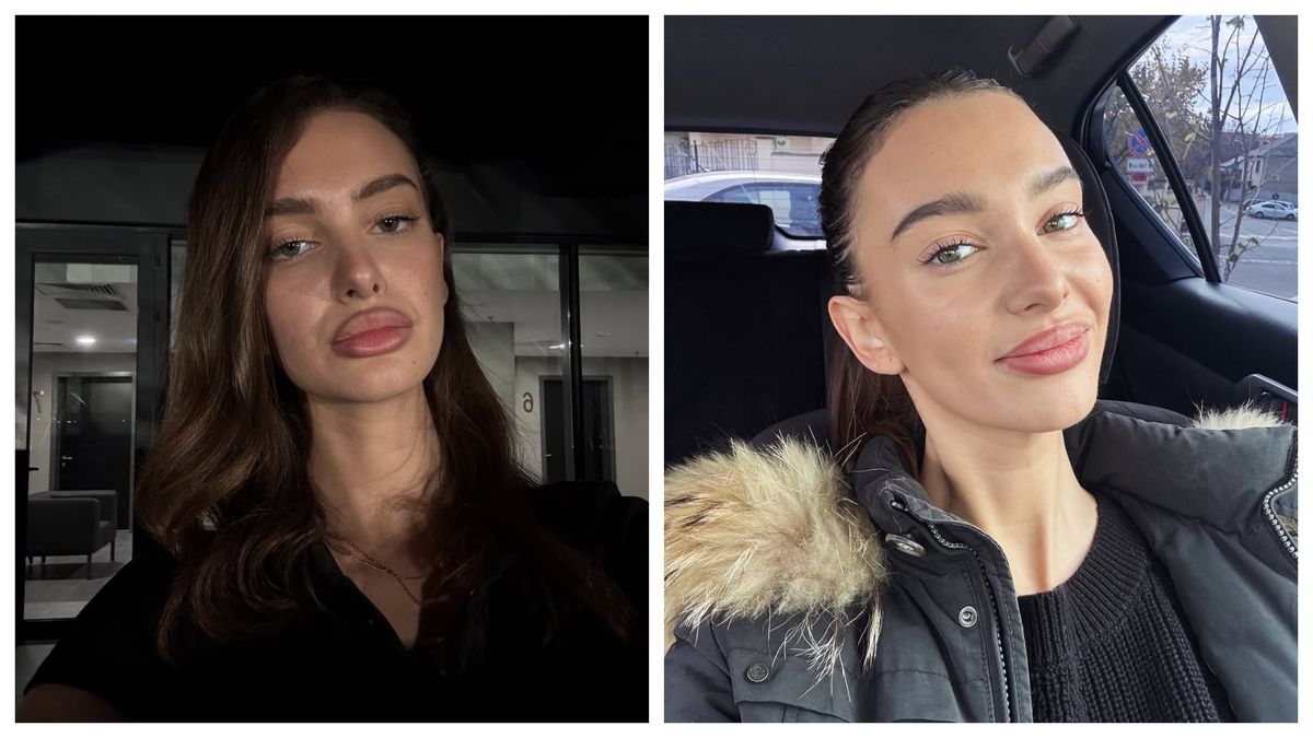 Olga Verbițchi, operată de două ori 