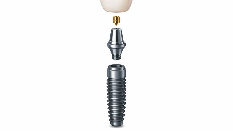 (P) De la diagnostic la restaurare: tot ce trebuie să știi despre un implant dentar Straumann