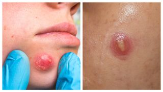 Coșul care nu trece ar putea fi, de fapt, cancer de piele?