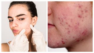 De ce apare acneea?! Factorul ascuns care te sabotează complet…Vezi mai mult