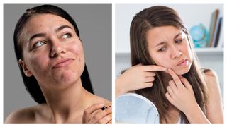 Greșeala care &icirc;ți distruge fața zilnic! Acneea&hellip;Vezi mai mult