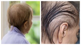 Vești șocante pentru femei despre căderea părului! Ce s-a aflat…Vezi mai mult