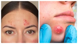 Afecțiunea care scapă de sub control și &icirc;ți DISTRUGE tenul&hellip;Vezi mai mult