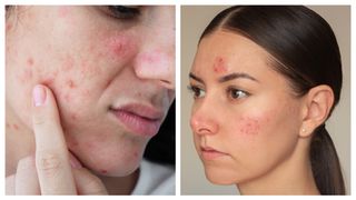 Ce NU ți-a spus nimeni despre acnee! Pasul pe care îl sari și te costă…Vezi mai mult