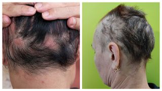 GREȘEALA banală care duce la căderea părului&hellip;Vezi mai mult