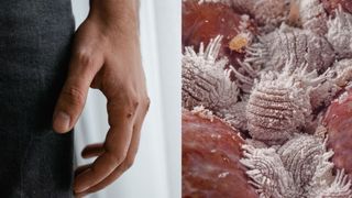 Creșteri alarmante ale cazurilor de scabie. Boala extrem de contagioasă se răsp&acirc;ndește rapid. Unde au fost raportate tot mai multe &icirc;mbolnăviri
