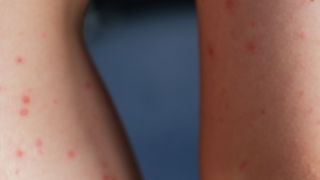 ALERTĂ în România! Numărul de cazuri a crescut la... Vezi mai mult