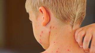 Este focar de rujeolă &icirc;n Europa. Țara unde au fost &icirc;nregistrate peste 60 de cazuri la copii