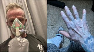 Un bărbat s-a dus la Urgențe cu pielea albastră. Panicați, medicii i-au pus masca de oxigen, apoi și-au dat seama ce avea, de fapt