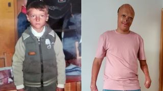 Exemplul de curaj al t&acirc;nărului mutilat de un incendiu &icirc;n copilărie. &bdquo;Nu mă raportez la ce a fost, ci la ce pot construi mai departe&rdquo;