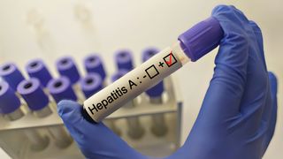 Alertă sanitară &icirc;n Constanța! Au fost descoperite 23 de focare de hepatită A